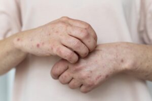 skin-allergy-person-s-arm-1-1024x681-1